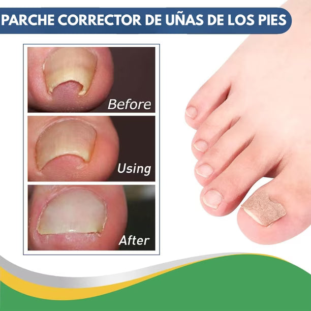 PediFlex™ - Solución Definitiva para Uñas Encarnadas