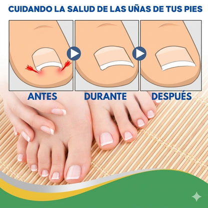 PediFlex™ - Solución Definitiva para Uñas Encarnadas